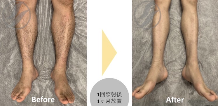 痛みのない全身脱毛（お顔、VIO込み）何度でも14980円の画像